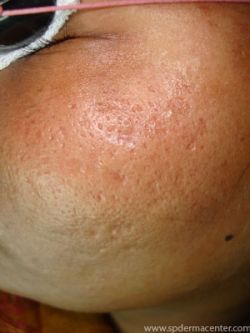Acne Scar Co2 Fraxel-Before